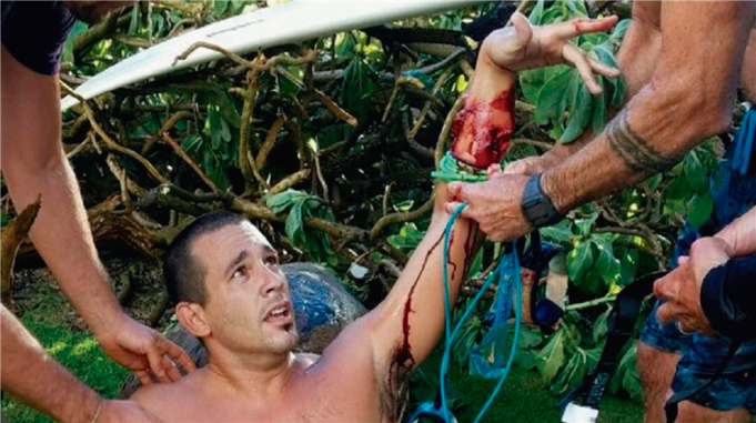 Im&aacute;genes fuertes: Surfista argentino sobrevive a ataque de tibur&oacute;n en Haw&aacute;i 
